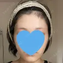 糸リフト / 脂肪吸引（顔） 銀座マイアミ美容外科 BEFORE サムネイル用