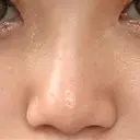 小鼻縮小（切開） Taide Suenaga Clinic（タイデスエナガクリニック） BEFORE サムネイル用