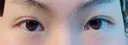 二重切開 / 目頭切開 / 上まぶたの脂肪取り 樹のひかり 形成外科・皮ふ科 BEFORE サムネイル用