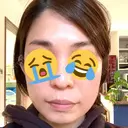 ボトックス（エラ・小顔） 品川美容外科 大宮院 BEFORE サムネイル用