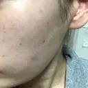 美肌レーザー / シミ取りレーザー たかはし形成外科･美容外科  BEFORE サムネイル用