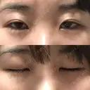 二重切開 / 眼瞼下垂（切開） ブリスクリニック形成外科・美容外科・美容皮膚科 福岡 BEFORE サムネイル用