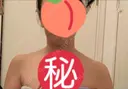 ボトックス（肩） 湘南美容クリニック 藤沢院 BEFORE サムネイル用