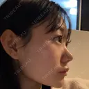 ヒアルロン酸注入（頬） 赤坂プレミアクリニック BEFORE サムネイル用