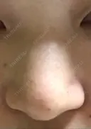 隆鼻術 / 鼻尖形成（切開） / 小鼻縮小（切開） / ほくろ・いぼ切除（肌） / 鼻翼挙上 東京形成美容外科 船橋院 BEFORE サムネイル用