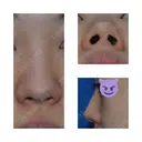 鼻尖形成（切開） / 小鼻縮小（切開） / スレッドノーズ / ヒアルロン酸注入（鼻） キップン整形外科 BEFORE サムネイル用