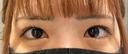 二重埋没 / タレ目形成・グラマラスライン（切開） R Beauty CLINIC 銀座院 BEFORE サムネイル用