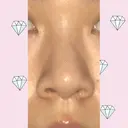 鼻尖形成（切開） / 小鼻縮小（切開） / 軟骨移植 / 鼻孔縁挙上 / 鼻尖縮小 ヴェリテクリニック 大阪院 BEFORE サムネイル用