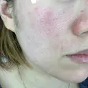 ピーリング（ニキビ・毛穴） / ダーマペン Zetith Beauty Clinic 銀座院 BEFORE サムネイル用
