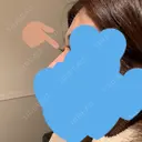 ヒアルロン酸注入（鼻） / ヒアルロン酸注入（目の下） Wクリニック 梅田院 BEFORE サムネイル用