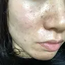 ダーマペン えいご皮フ科 奈良院 BEFORE サムネイル用