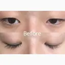 二重切開 / 目頭切開 / 上まぶたたるみ取り サラ美容外科 BEFORE サムネイル用