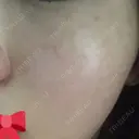 糸リフト ニューセンス皮膚科クリニック BEFORE サムネイル用