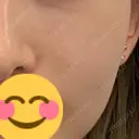 毛穴洗浄（ハイドラフェイシャルなど） B-LINE CLINIC 池袋院 BEFORE サムネイル用
