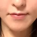 骨切り（あご） / 輪郭修正 / ボトックス（エラ・小顔） 心斎橋コムロ美容外科クリニック BEFORE サムネイル用