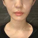 ボトックス（肩） ルラ美容クリニック 新宿院 BEFORE サムネイル用