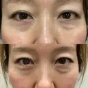 クマ治療 / 下まぶたたるみ取り / 下まぶたの脂肪取り セオリークリニック BEFORE サムネイル用