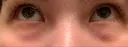 下まぶたの脂肪取り 品川美容外科 仙台院 BEFORE サムネイル用