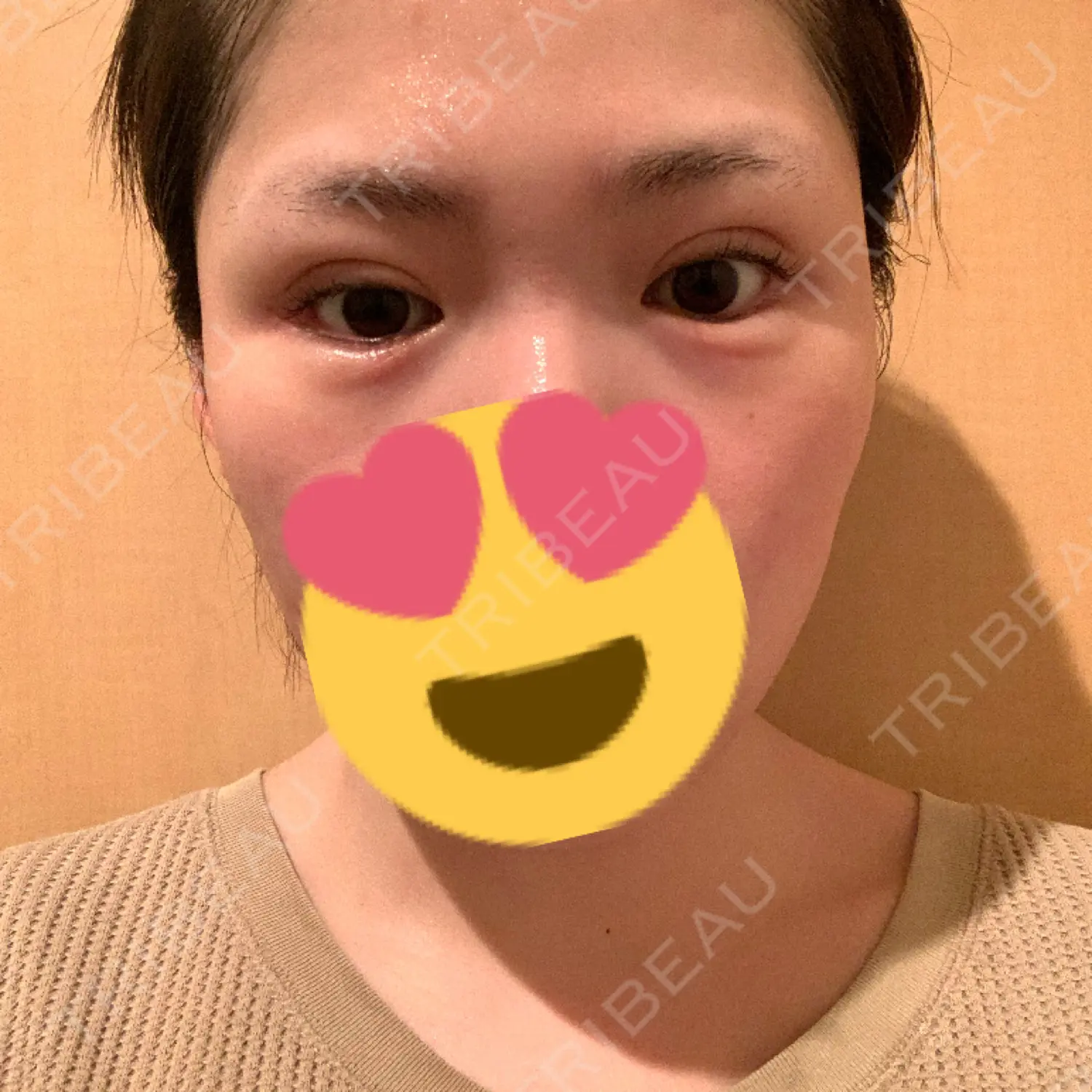 施術後の写真