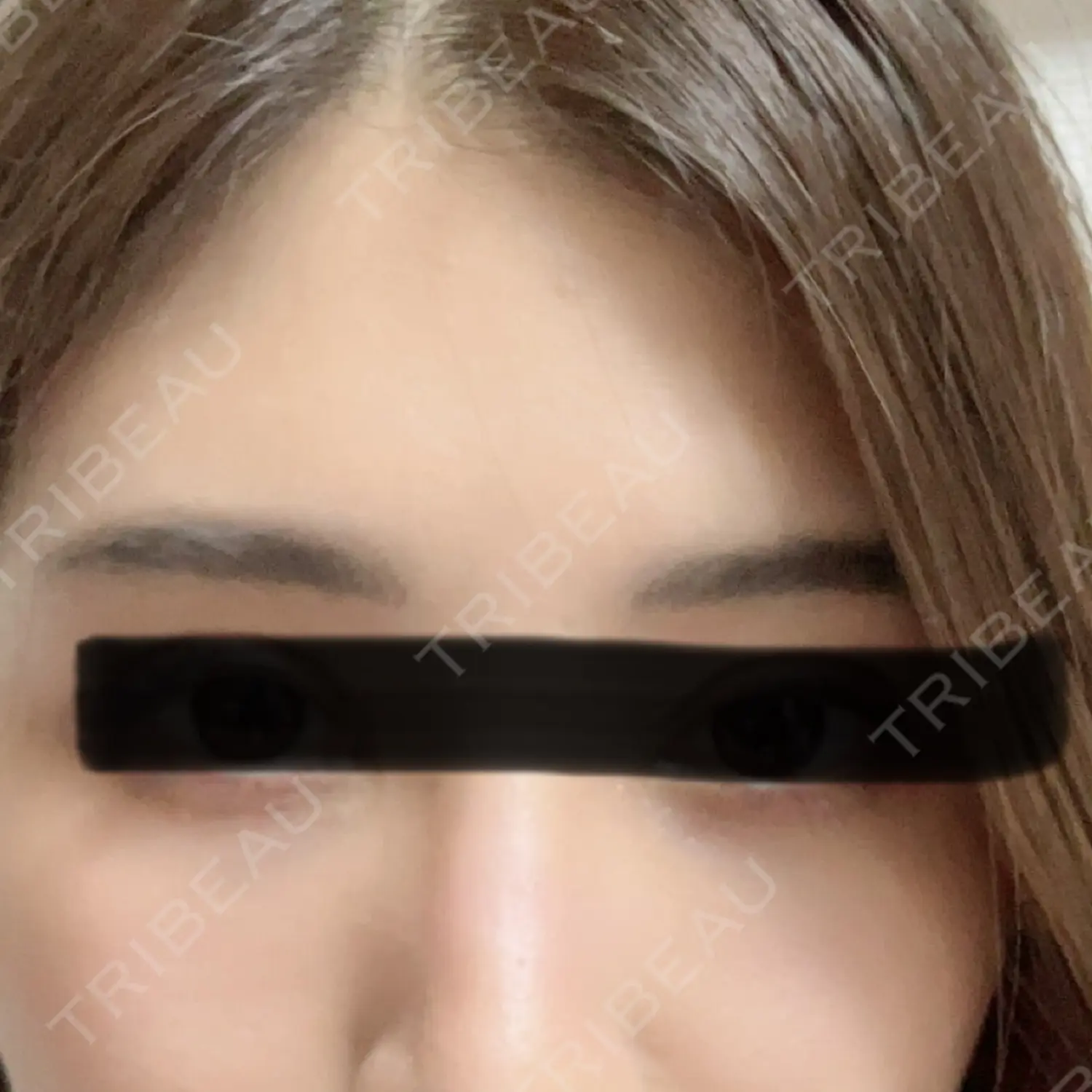 施術後の写真