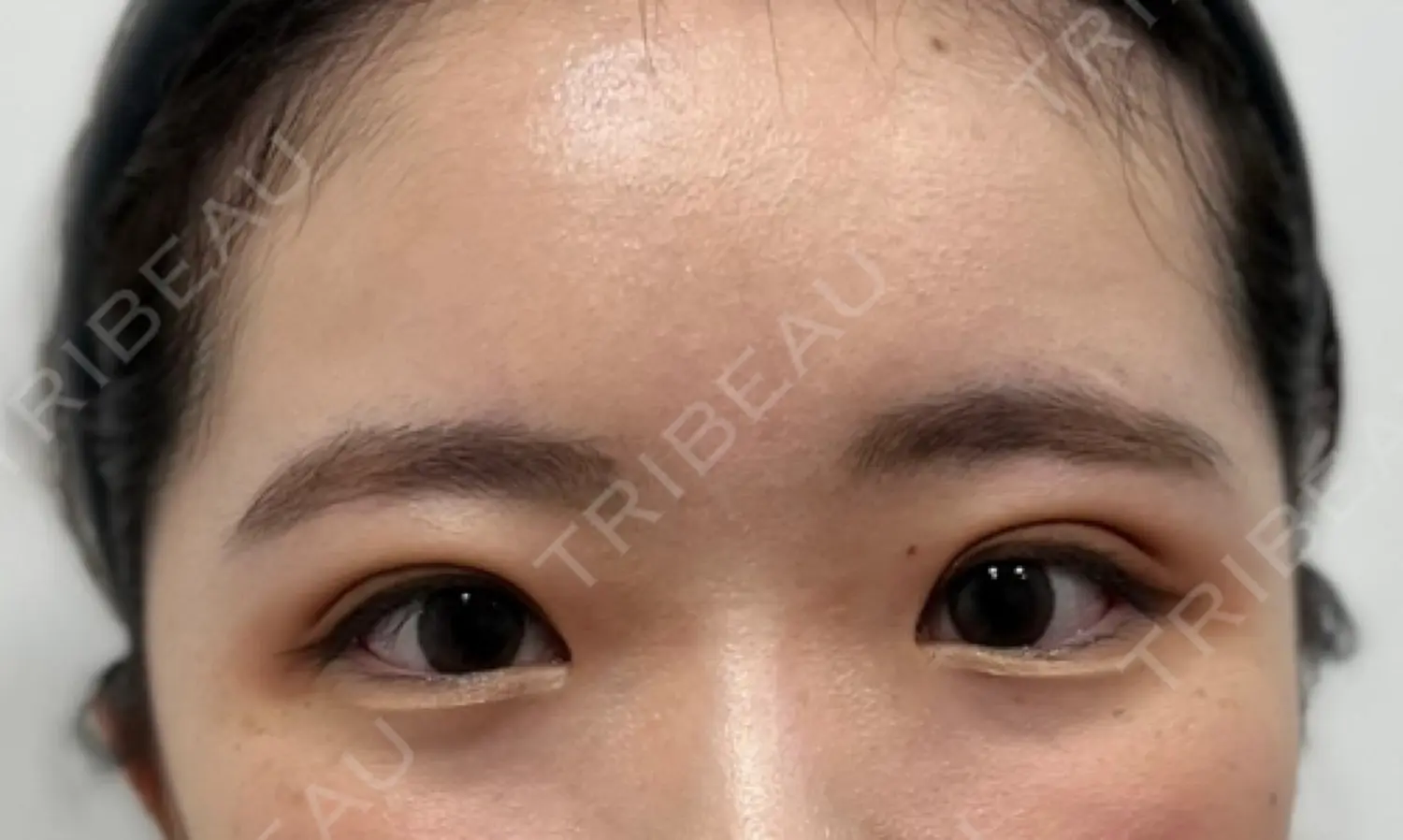 施術後の写真