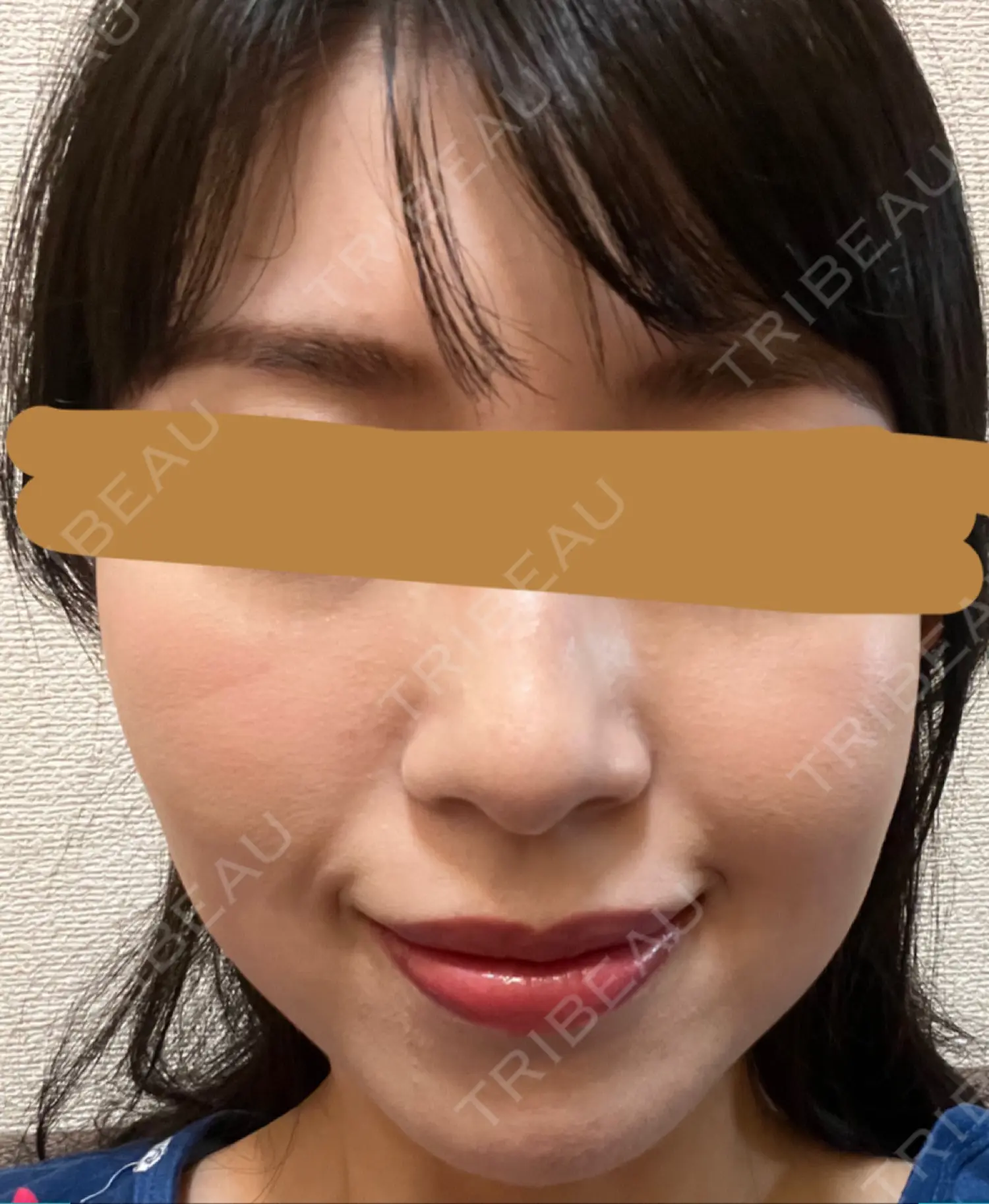 施術後の写真