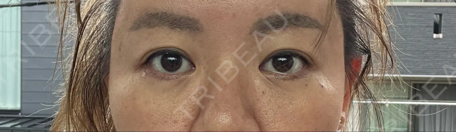 施術後の写真