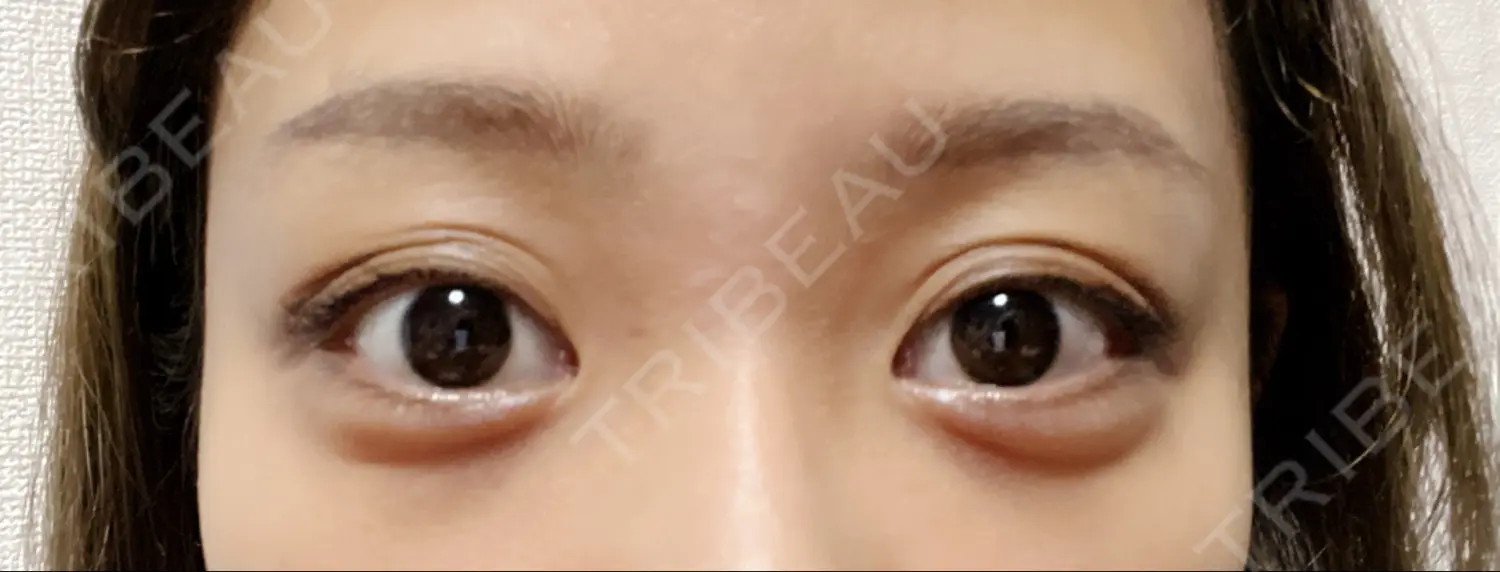 施術後の写真