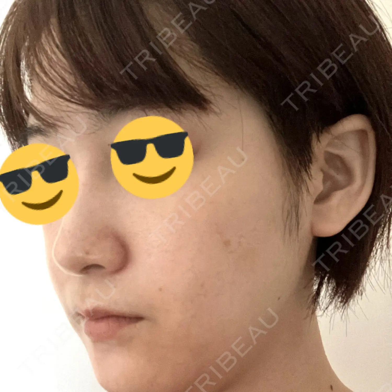 施術後の写真