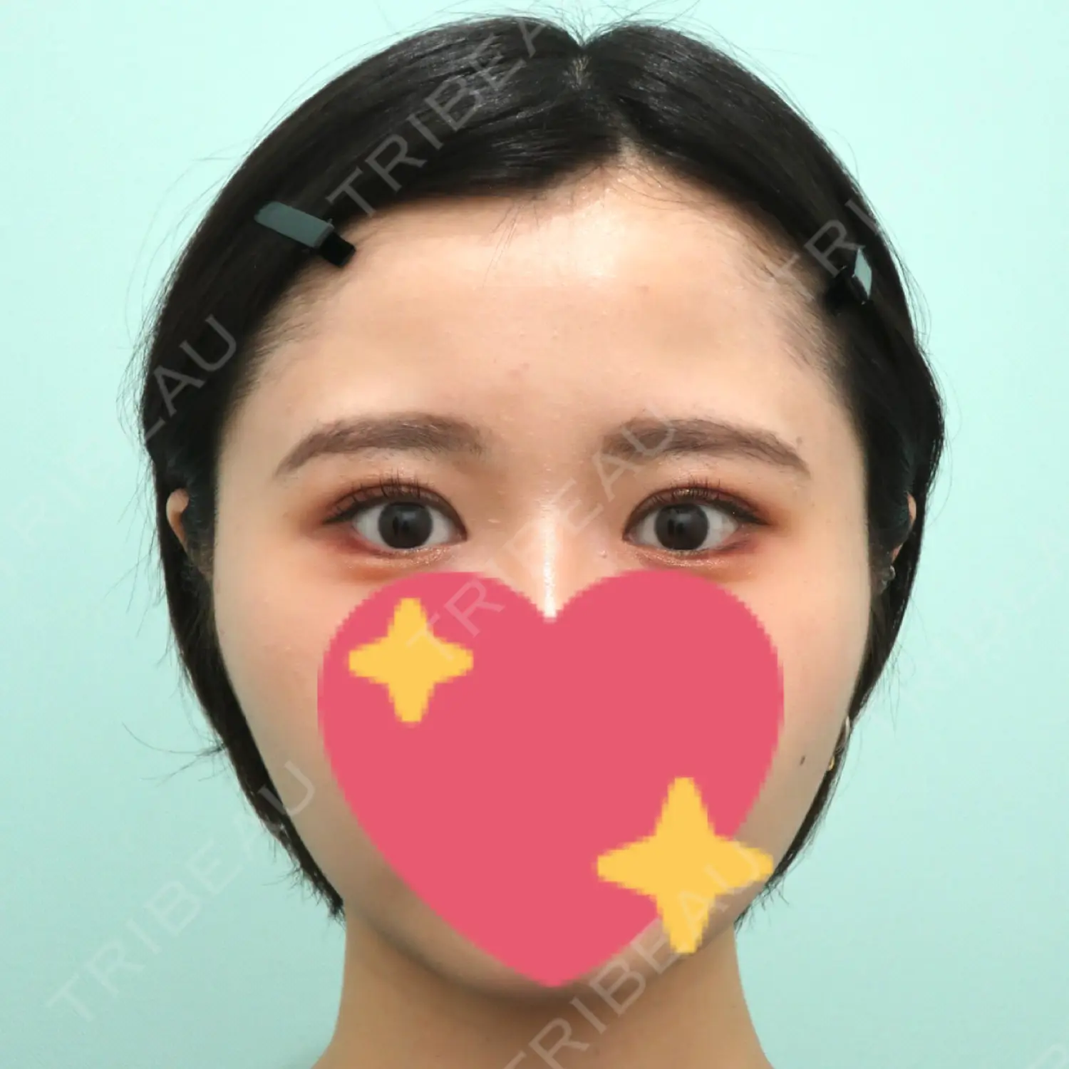 施術後の写真