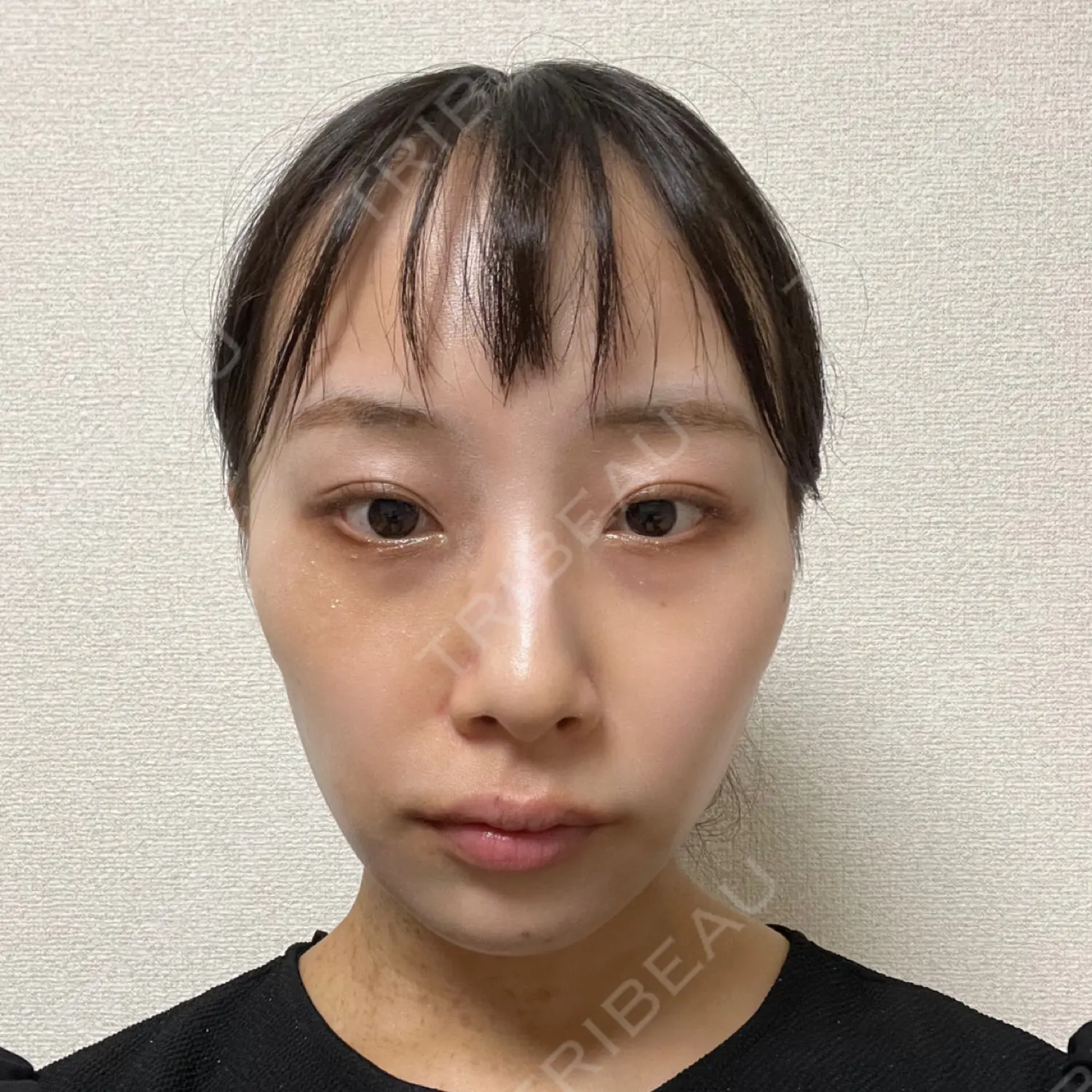 施術後の写真