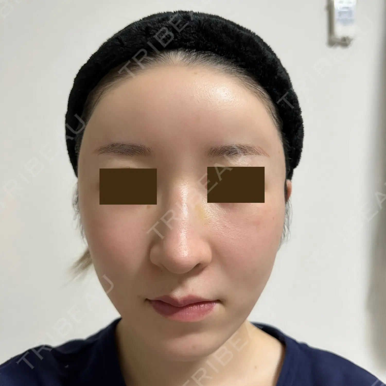 施術後の写真