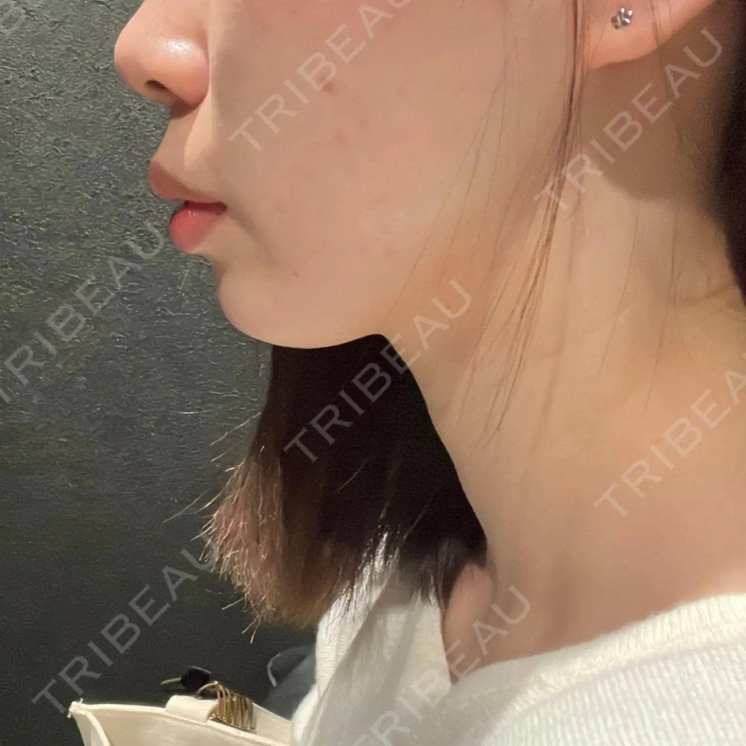 施術後の写真