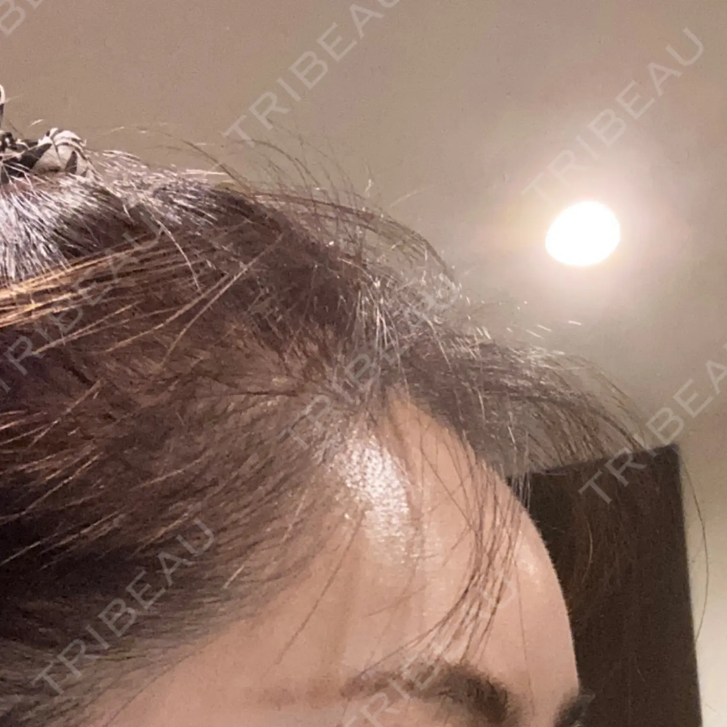 施術後の写真