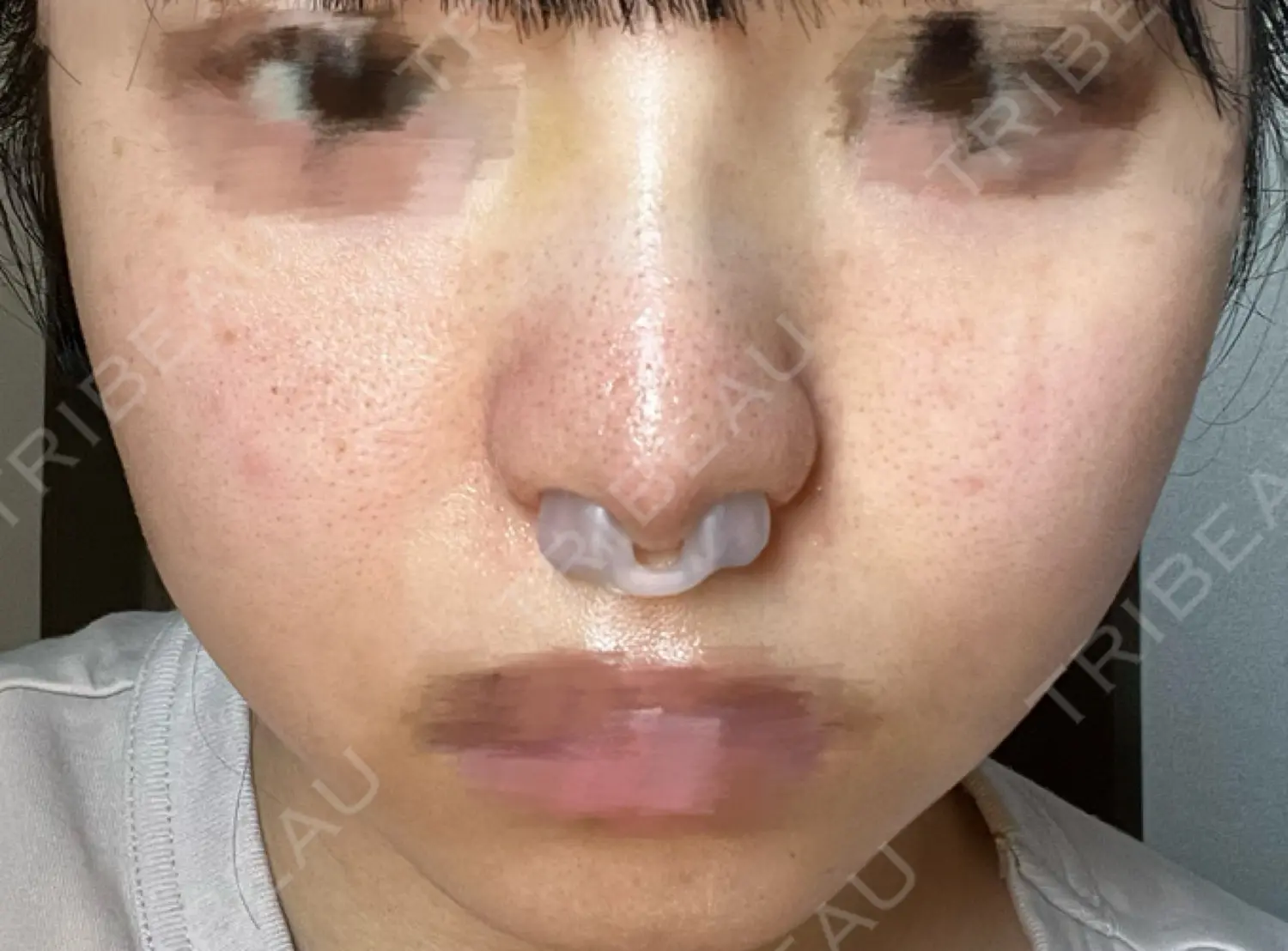 施術後の写真