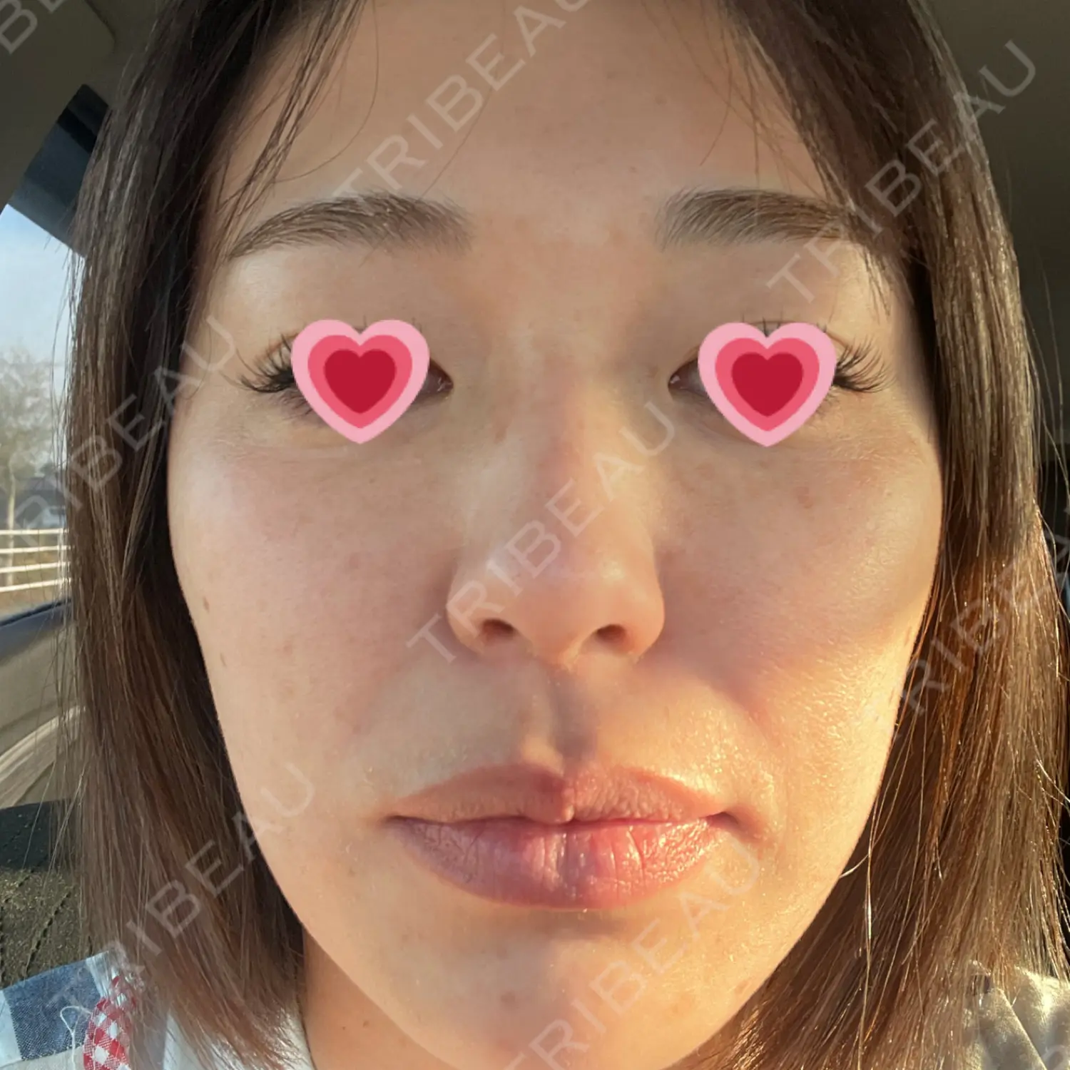 施術後の写真