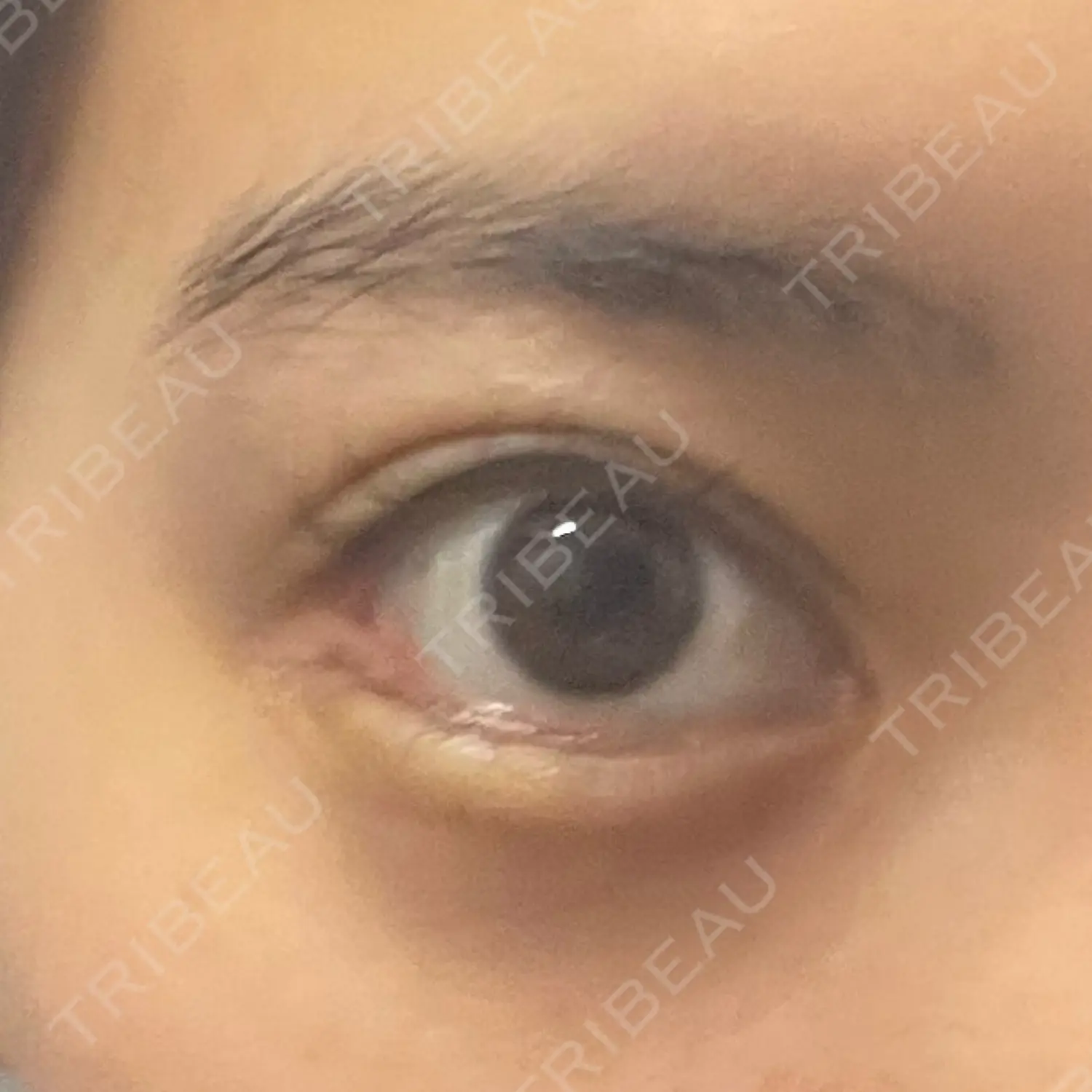 施術後の写真