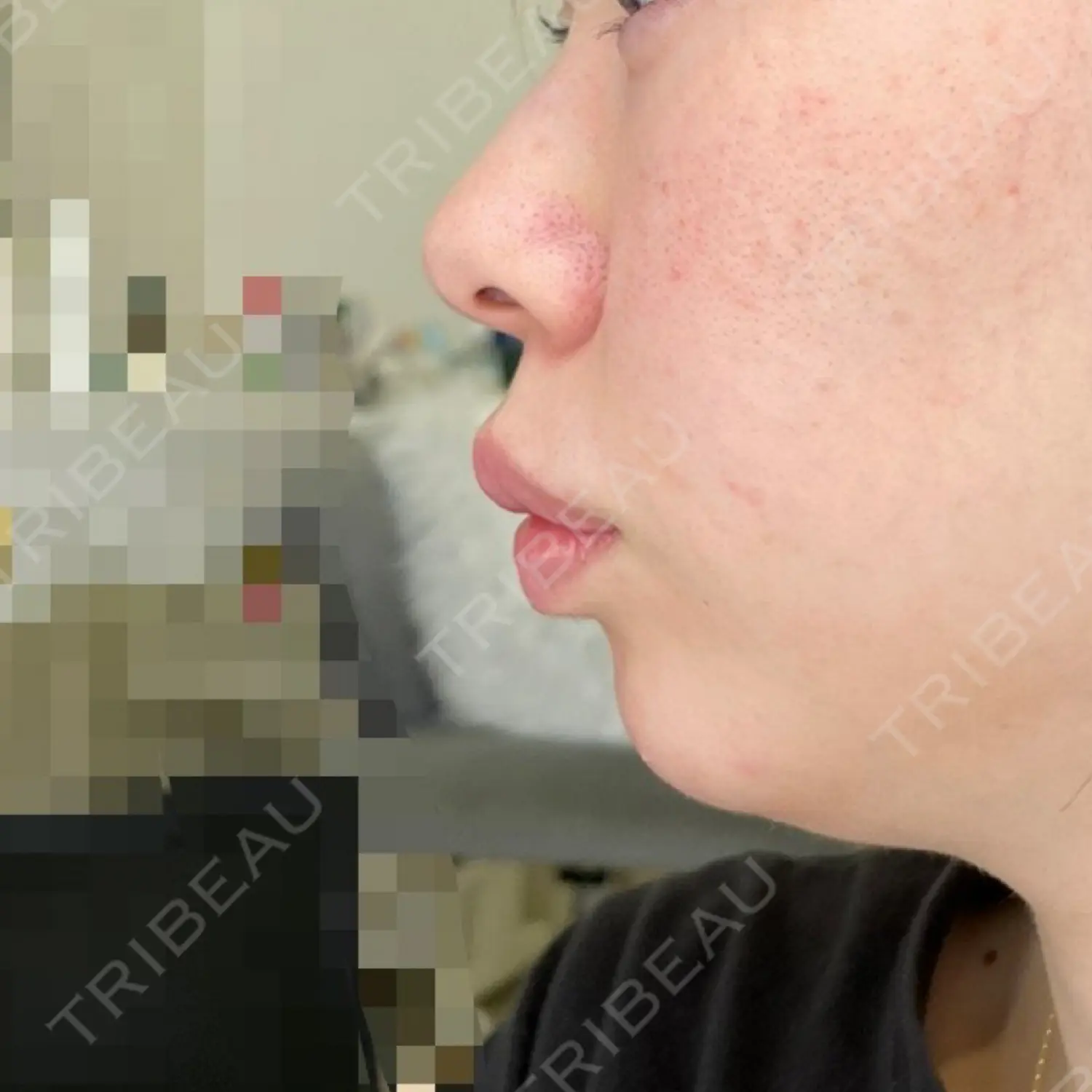施術後の写真