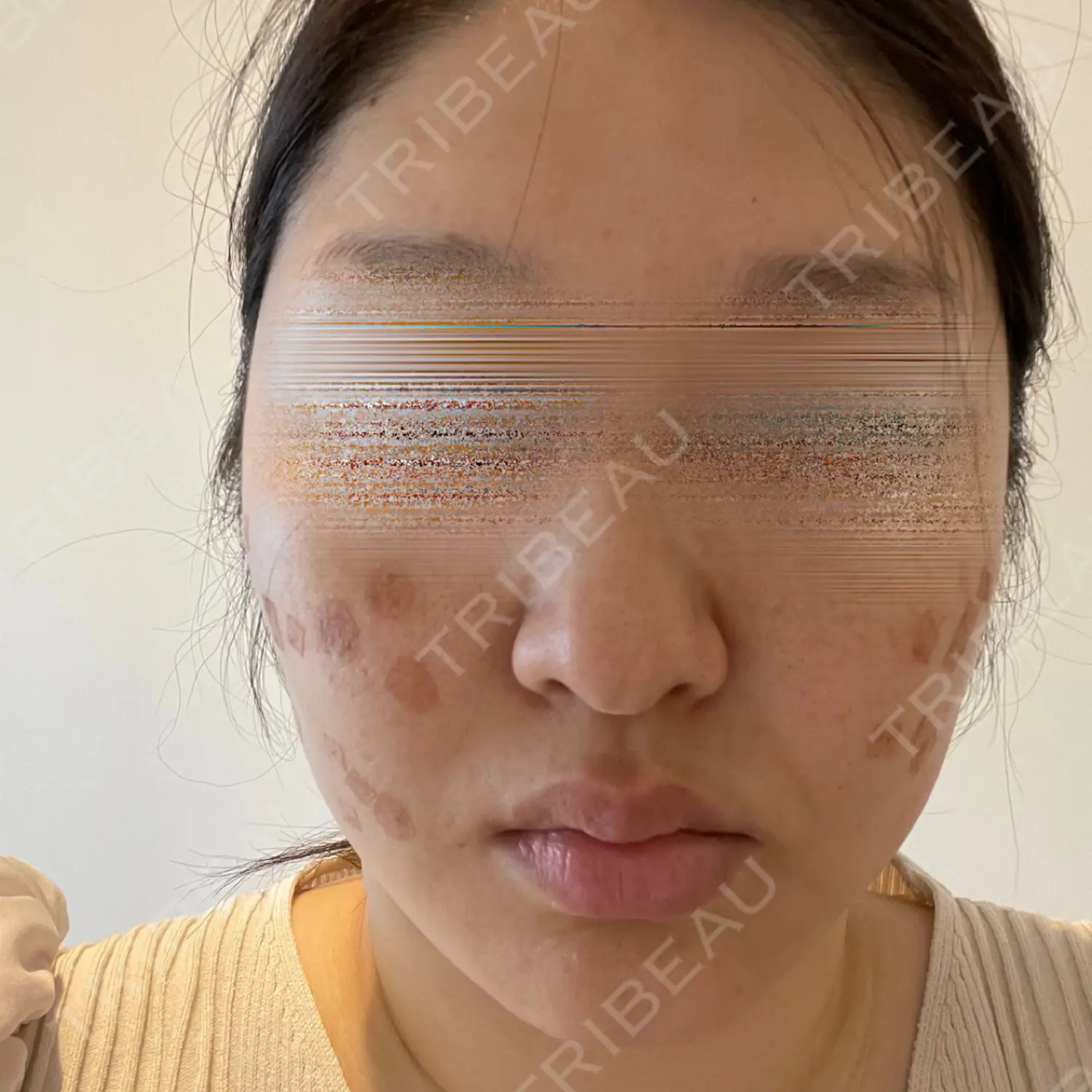 施術後の写真