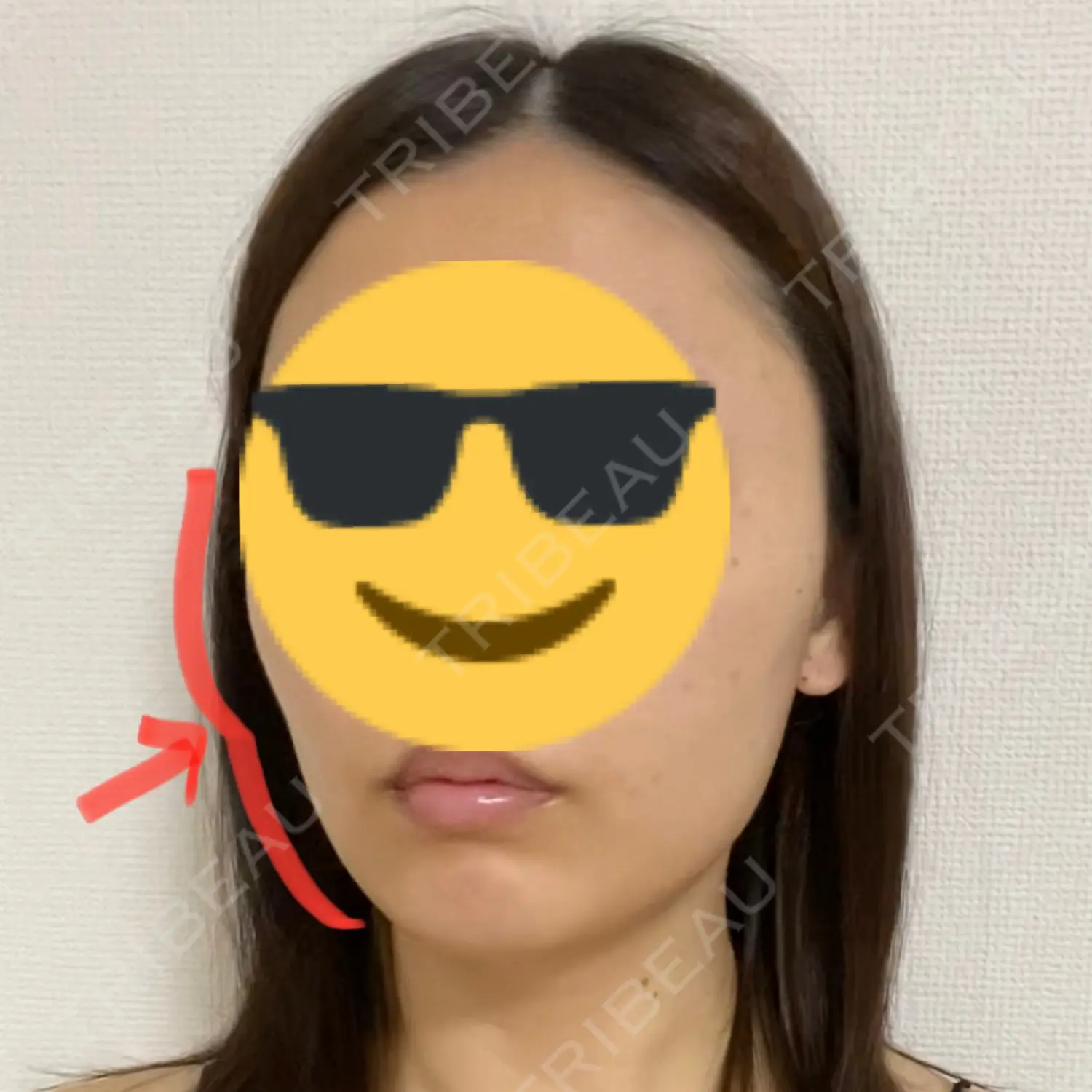 施術後の写真