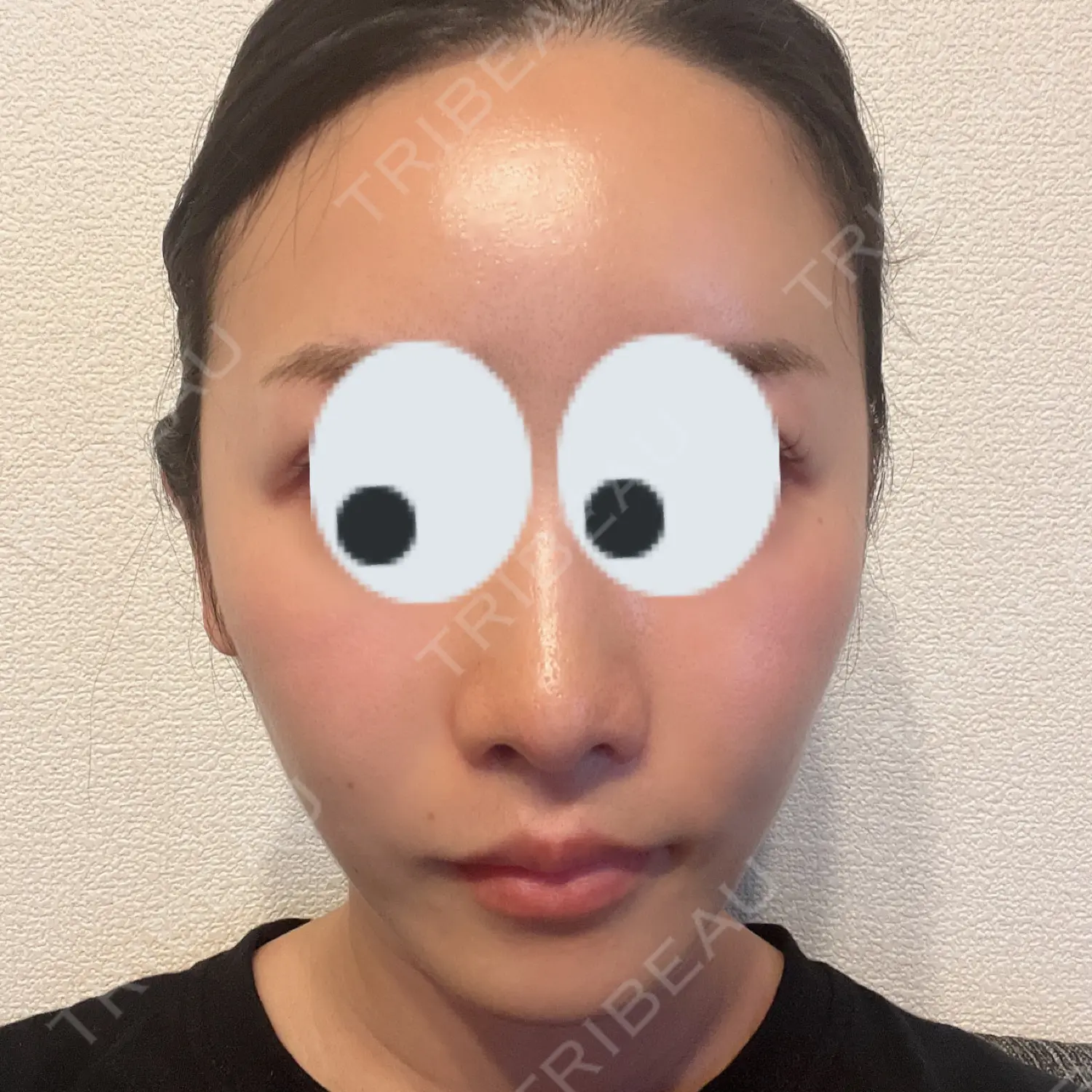 施術後の写真