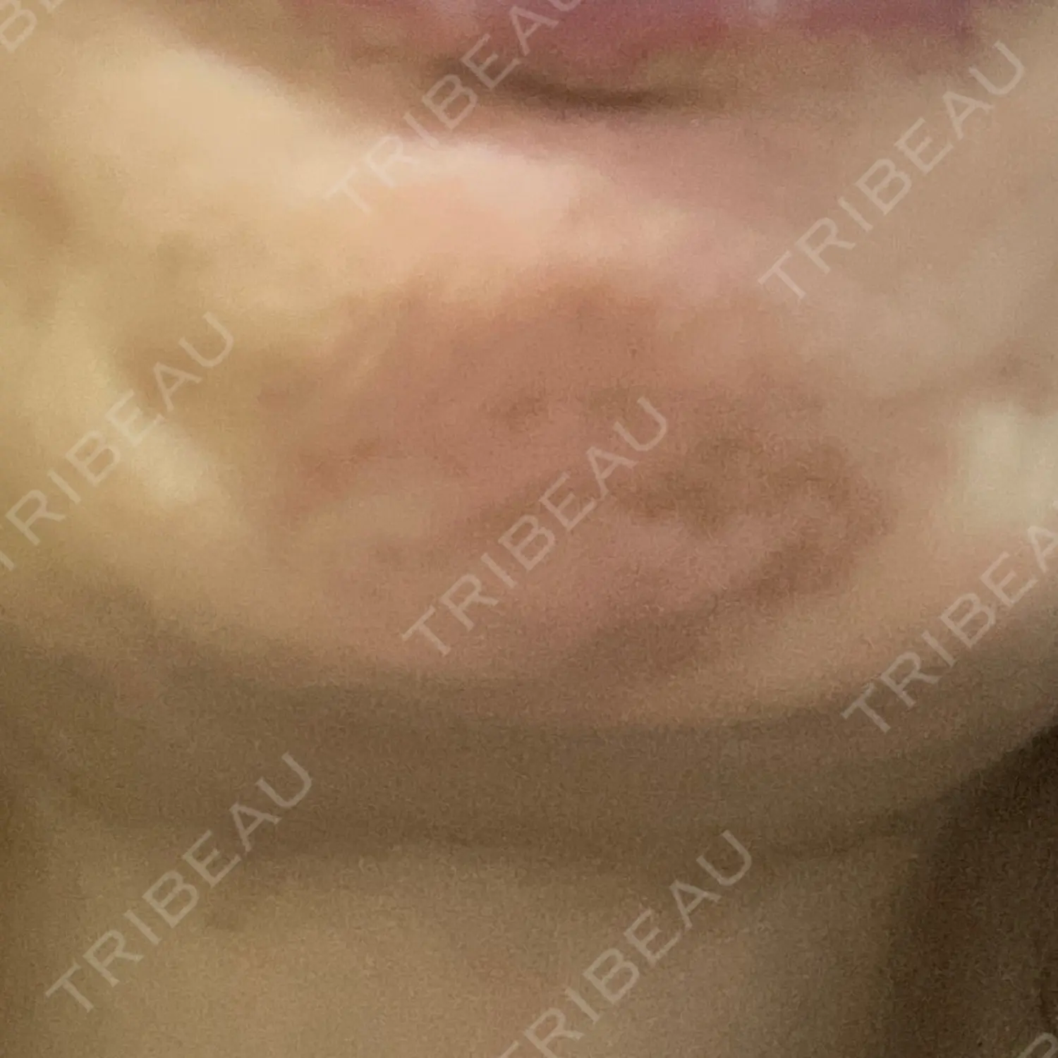 施術後の写真