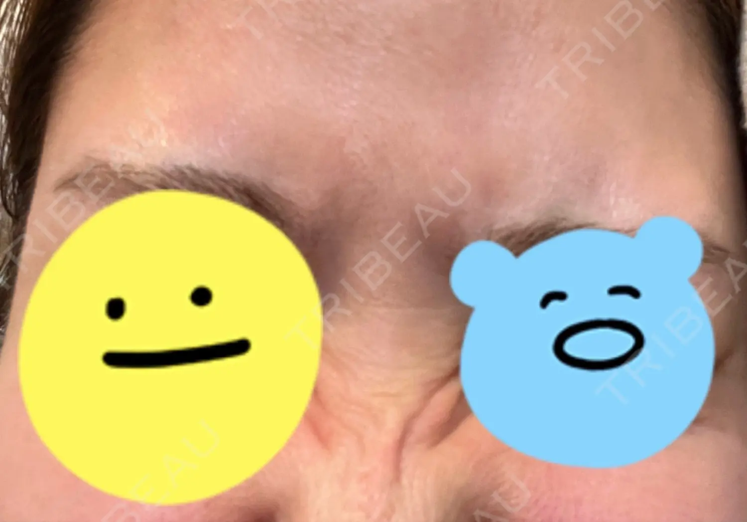 施術後の写真