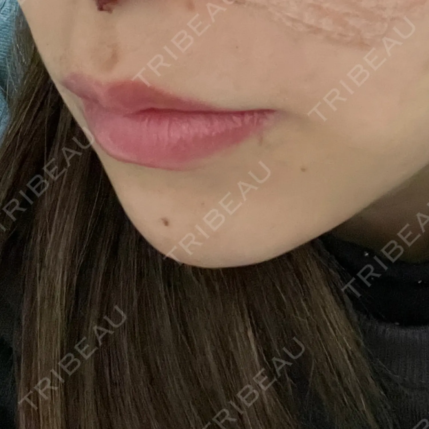 施術後の写真