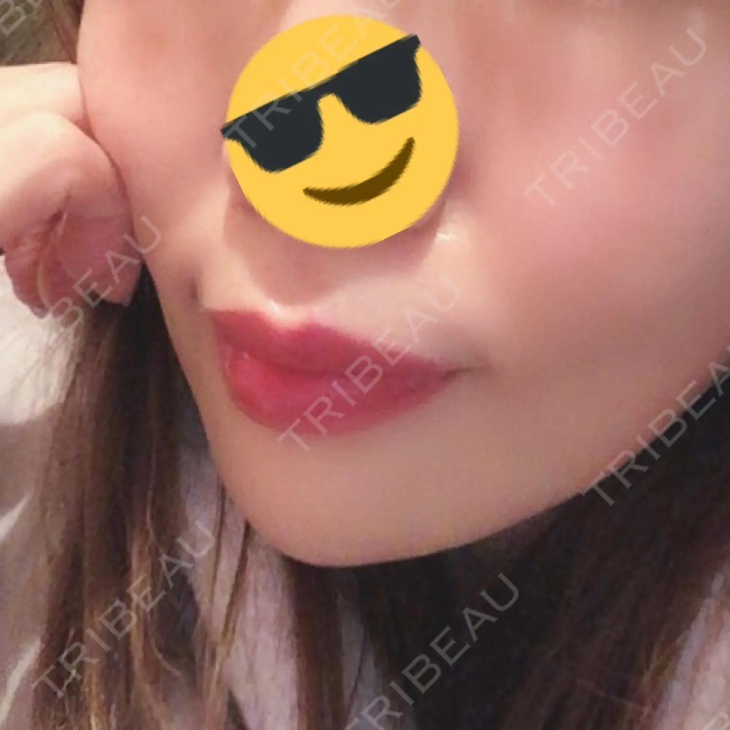 施術後の写真