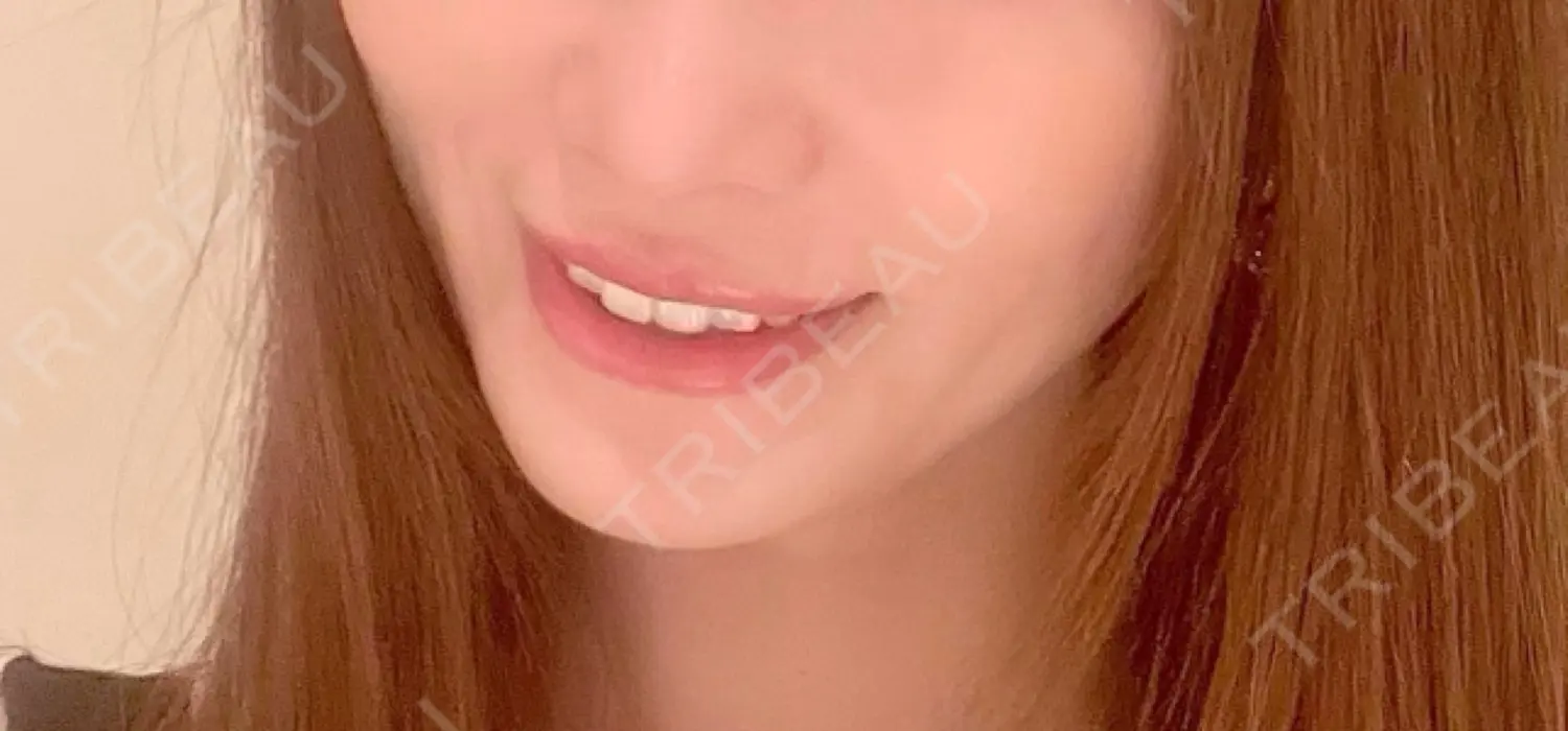 施術後の写真