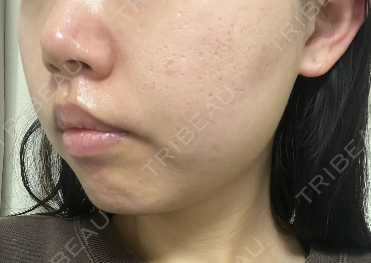 施術後の写真