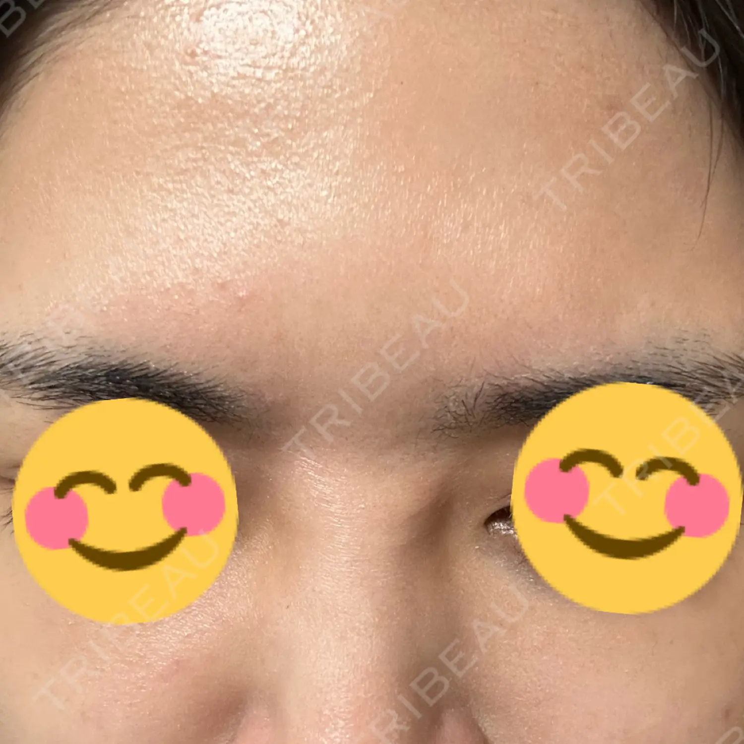 施術後の写真