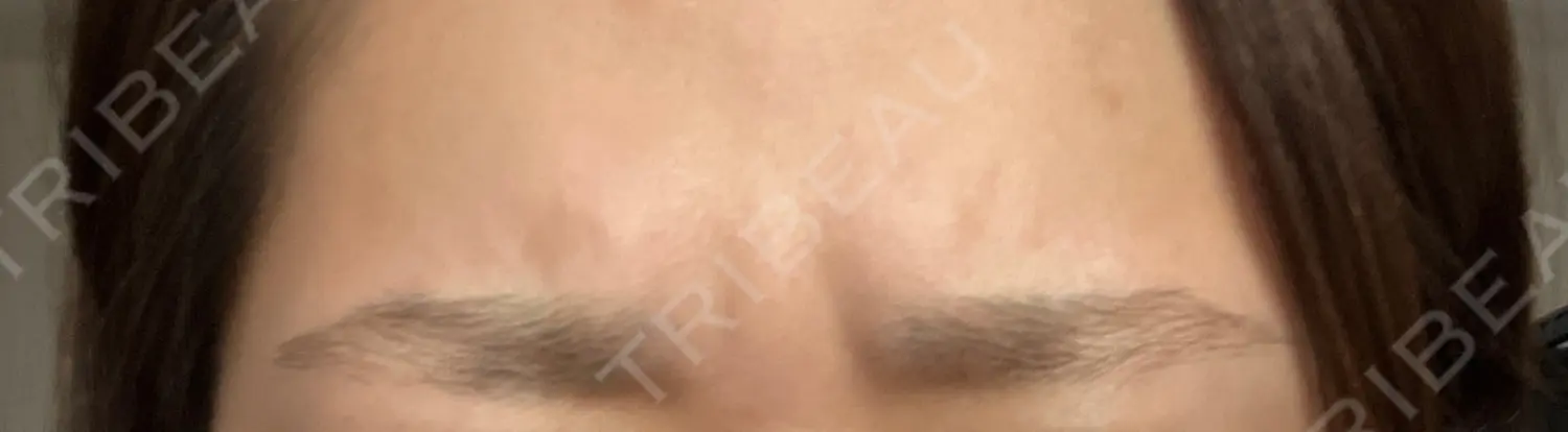 施術後の写真