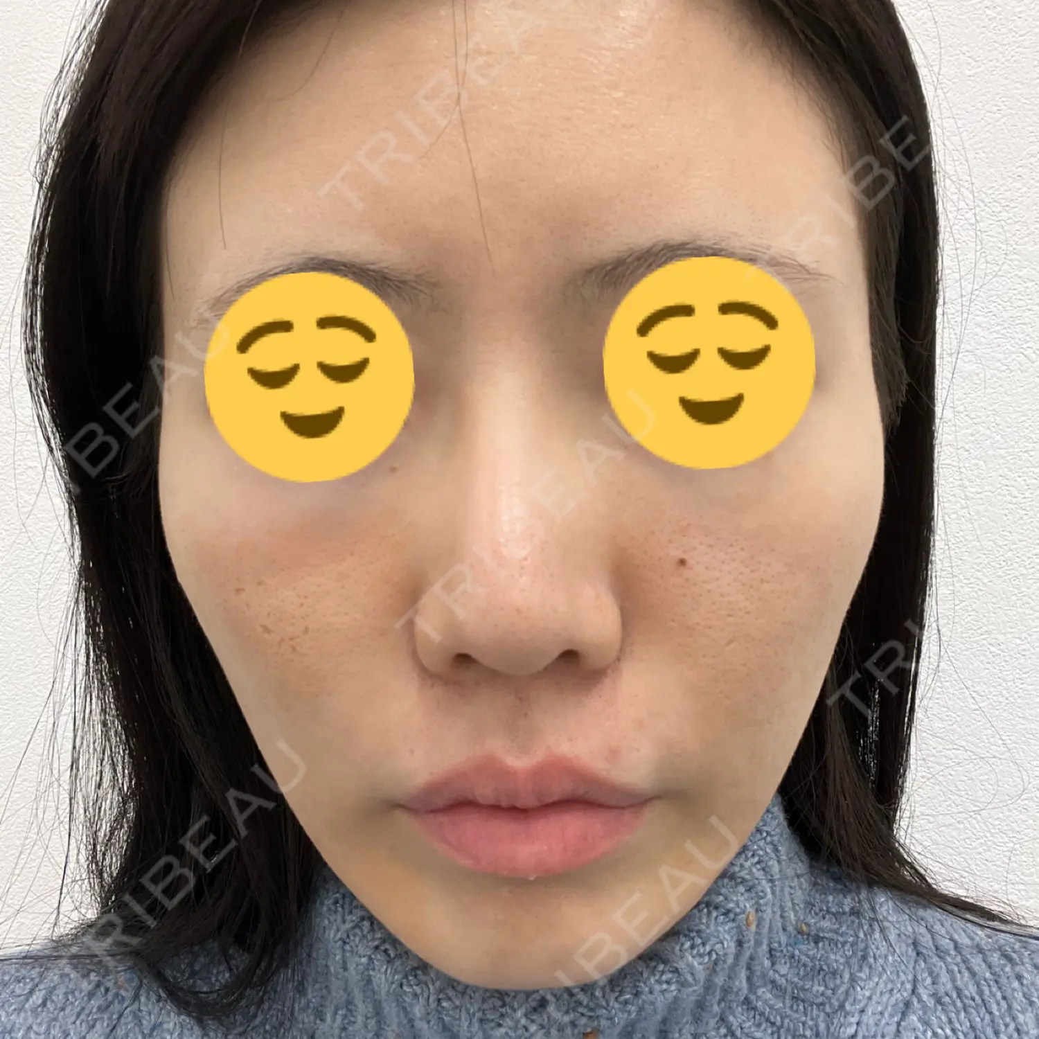 施術後の写真